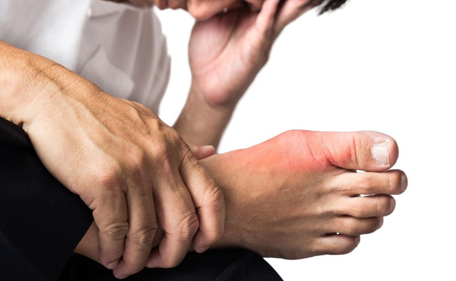 Hautveränderungen bei Gicht: Ursachen und Symptome Hautveränderungen bei Gicht: Ursachen und Symptome