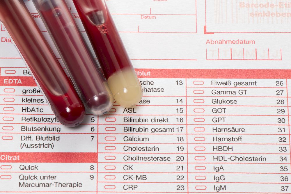 Glukose (Glc) bei der Diagnose und Überwachung von Gicht